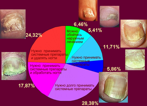 Лікування грибка нігтів на ногах народними засобами: як швидко позбутися від грибка 