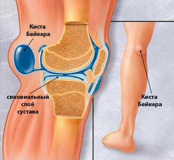 Біль під коліном: ззаду, при згинанні, причини, що це, лікувати