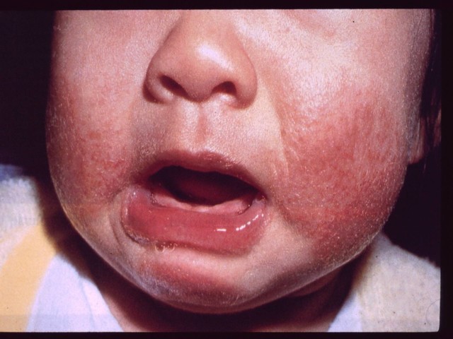 Алергічний дерматит у дітей: фото, симптоми і лікування