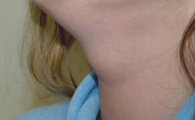 Серединна кіста шиї: причини і лікування у дитини і дорослого