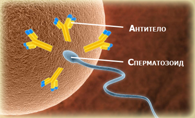 Імунологічне безпліддя у чоловіків і жінок: що це таке, причини і лікування