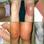 Синостоз колінного суглоба: що це таке, симптоми, лікування, профілактика
