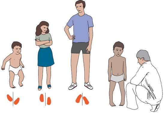 Як лікувати деформацію стопи і гомілки у дитини