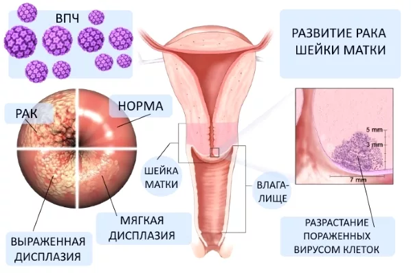 Біопсія шийки матки - що це таке, як проводиться біопсія, розшифровка