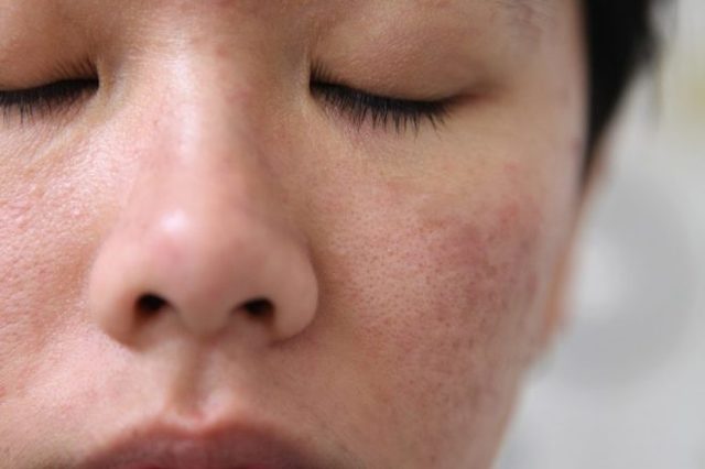 Розширені пори на обличчі: як позбутися в домашніх умовах, догляд за пористою шкірою