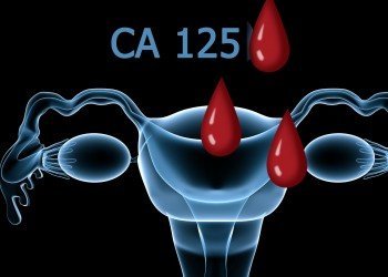 Онкомаркер СА 125: норма і розшифровка результатів аналізу крові, норма СА 125 у жінок
