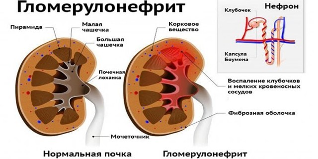 Гломерулонефрит: симптоми, форми, причини, діагностика, методи лікування гломерулонефриту і ускладнення даного захворювання