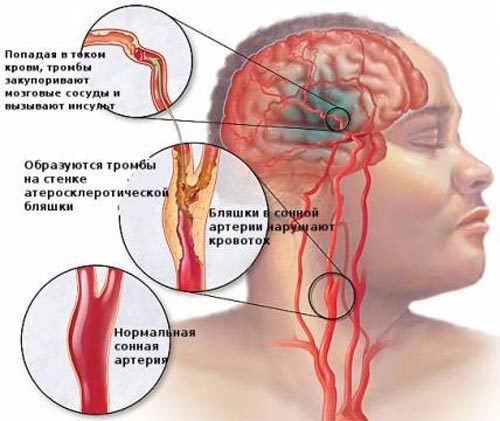 УЗД судин голови і шиї - особливості проведення УЗД судин головного мозку.