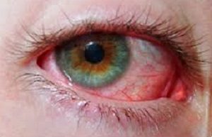 Болить очей зсередини: причини болю всередині очного яблука при натисканні, що робити
