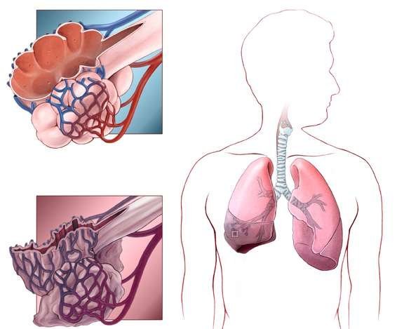 Ателектаз легенів: механізм розвитку, клінічні прояви, методи обстеження та лікування