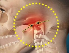 Артроз скронево-нижньощелепного суглоба (СНЩС): причини виникнення, характерні прояви, лікування в клініці і в домашніх умовах