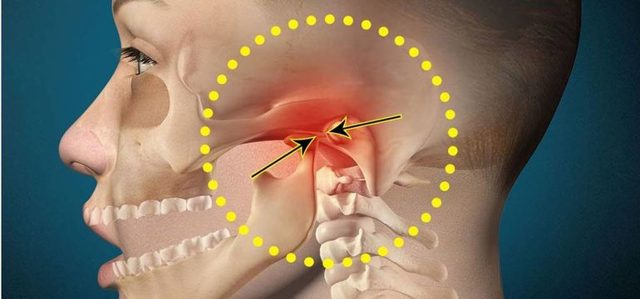 Артроз скронево-нижньощелепного суглоба (СНЩС): причини виникнення, характерні прояви, лікування в клініці і в домашніх умовах