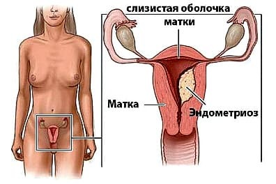 Чи можливо завагітніти при ендометріозі матки: 1 або 2 ступеня