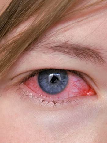 Алергічний кератит - симптоми, лікування у дитини і у дорослого