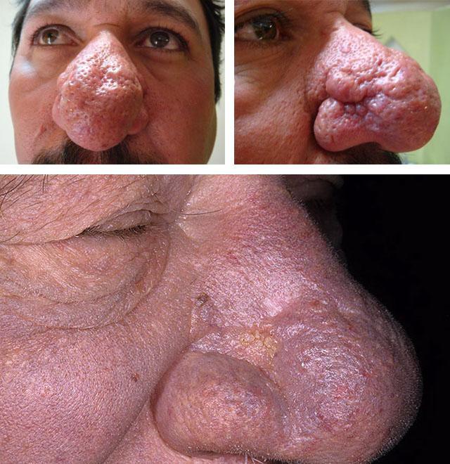 Рінофіма носа: симптоми, причини і методи лікування