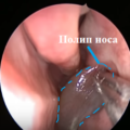 Видалення поліпів у носі: ендоскопічна і лазерна операції