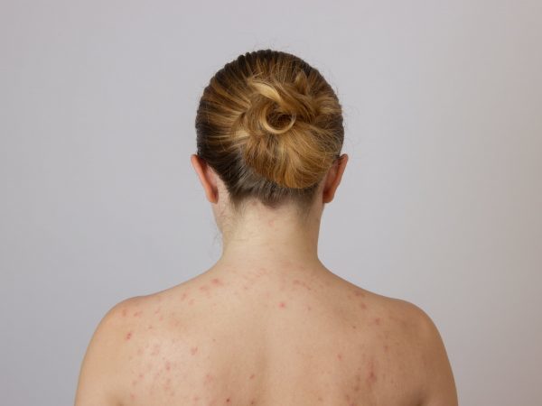 Актініческій кератоз шкіри: що це таке, симптоми, лікування сонячного кератозу