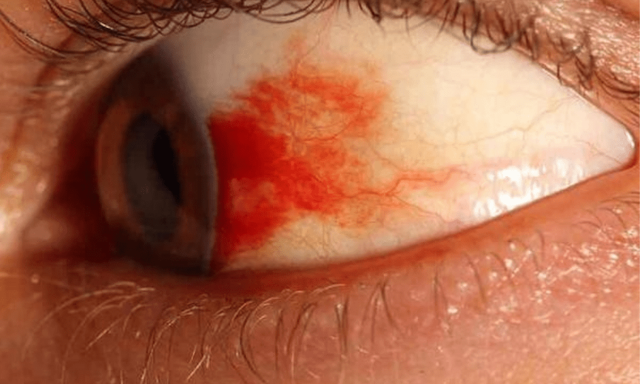 Лопнула судина в оці: причини, лікування, які краплі капати, щоб прибрати червоність