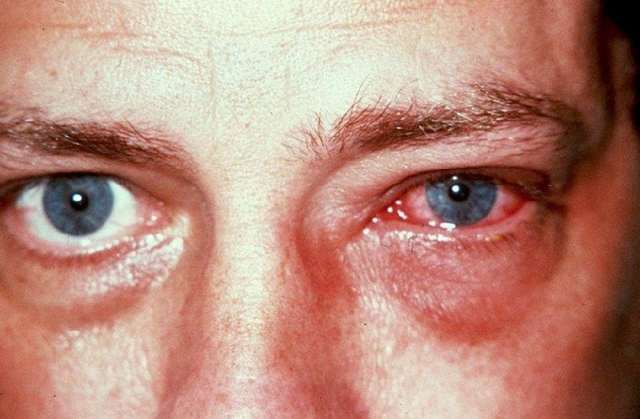 Алергічний кон'юнктивіт: симптоми, причини, види, методи лікування алергічного кон'юнктивіту