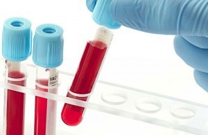 Множинна мієлома крові: чи можна вилікуватися, прогноз, лікування плазмоцитоми