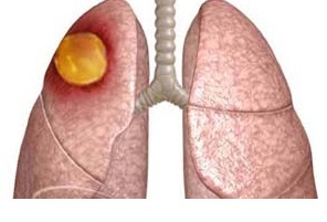 Абсцес легені - симптоми і скарги, діагностика, лікування та профілактика.