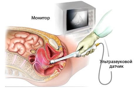 Кистома яєчника: правого, лівого, що це таке, як лікувати, операція при великій кістоми