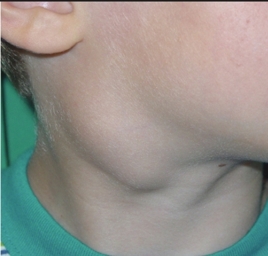 Рак носа і навколоносових пазух: симптоми, причини, форми і стадії розвитку