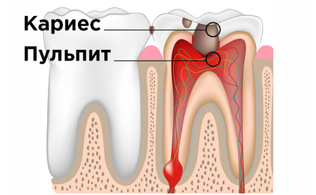 Пульпіт зуба: що це таке, як лікують пульпіт, хронічний і гострий пульпіт
