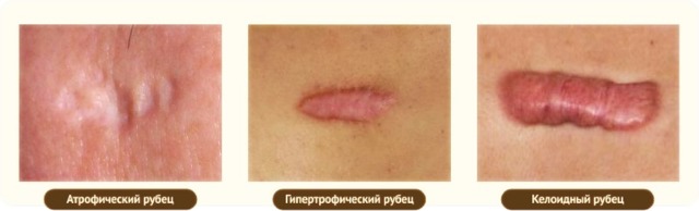 Микродермабразия: показання та протипоказання, наслідки при рубцях і шрамах