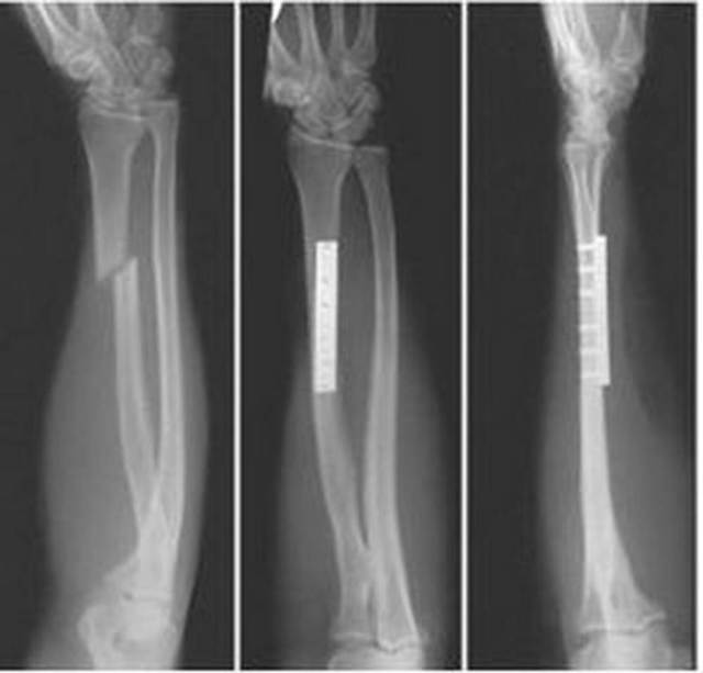 Осколковий перелом ліктьової кістки руки зі зміщенням і без: наслідки, лікування, операція