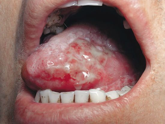 Гальваноз порожнини рота: симптоми і лікування, профілактика