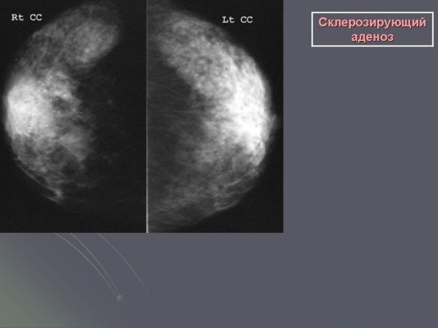 Фиброзирующий аденоз молочної залози: що це таке, УЗД картинка і рентген, лікування