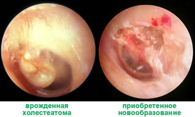 Холестеатома вуха: що це таке, симптоми, лікування, операція