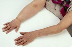 Лімфостаз нижніх і верхніх кінцівок: ознаки і домашнє лікування