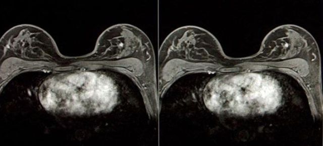 МРТ молочних залоз з контрастом: що показує, як проводиться, підготовка