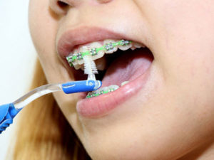 Зубна пластинка для дітей або брекети - що краще, показання до установки