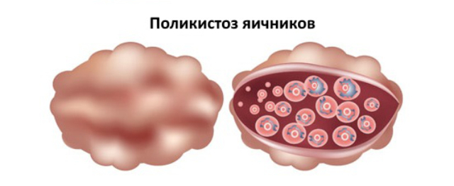 Полікістоз яєчників: симптоми, причини, лікування полікістозу яєчників