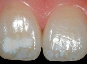 Гіпоплазія емалі зубів: причини пошкодження, стадії розвитку, методи терапії і профілактика