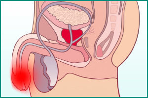 Ріжучі болі при сечовипусканні у чоловіків і виділення з уретри: причини, діагностика, методи лікування 