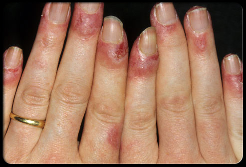 Туберкульоз шкіри - симптоми початкової стадії, причини, лікування дорослих і дітей