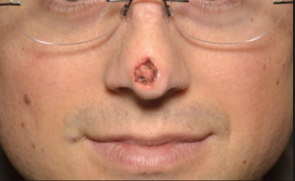 Рак носа і навколоносових пазух: симптоми, причини, форми і стадії розвитку