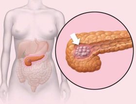 Инсулинома підшлункової залози: причини виникнення, характерні симптоми, методи обстеження та лікування