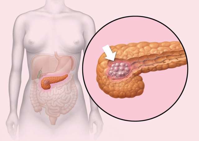 Инсулинома підшлункової залози: причини виникнення, характерні симптоми, методи обстеження та лікування