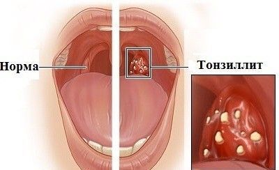 Хронічний субкомпенсований тонзиліт: причини появи і лікування