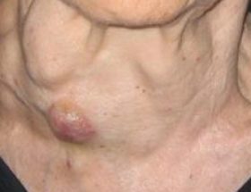 Гіперплазія щитовидної залози: ступеня патології, перші ознаки і методики лікування