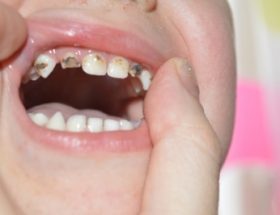 Сріблення зубів у дітей при карієсі молочних зубів: що це, фото до і після, відгуки лікарів і батьків