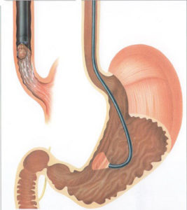 ЕГДС шлунка: коли показана, підготовка, специфіка проведення, відгуки