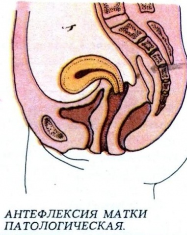 Положення матки Anteflexio: нормальне положення матки в малому тазу