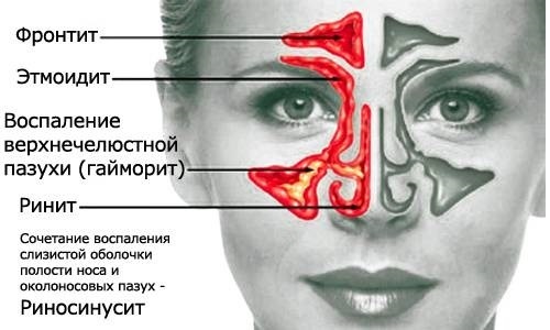 КТ пазух носа: як роблять, що показує і як проводиться?