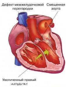 Серцевий горб у дітей і дорослих, його причини і лікування